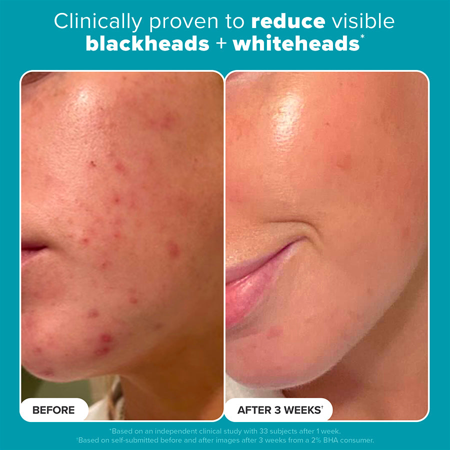 Skin Perfecting Jumbo 2% BHA Liquid Exfoliant 236ML - Paula's Choice Thailand